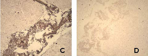 Figure 3: Fluorescence (A), bright field (B), and bright field image following silver development (C) of cytokeratin stained tonsil tissue with mouse anti-human AE1/AE3 primary and 5 nm gold anti-mouse-IgG-Alexa Fluor 594 secondary antibody; D is corresponding control slide in which the primary mouse anti-human antibody was excluded.