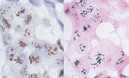 [EnzMet vs. DAB: ISH of HER2 gene in amplified tissue (36k)]