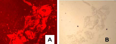 Figure 3: Fluorescence (A), bright field (B), and bright field image following silver development (C) of cytokeratin stained tonsil tissue with mouse anti-human AE1/AE3 primary and 5 nm gold anti-mouse-IgG-Alexa Fluor 594 secondary antibody; D is corresponding control slide in which the primary mouse anti-human antibody was excluded.