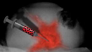 Previous attempts to directly inject tumors with iron particles would reach only portions of a tumor.