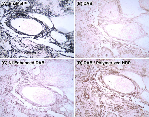 Comparison of EnzMet with conventional DAB immunohistochemistry and enhanced DAB, showing superior contrast and sensitivity even without further amplification. Cytokeratins in paraffin-embedded bladder tumor stained with monoclonal primary antibody (AE1/AE3, Dako) and peroxidase secondary with (A) EnzMet;(B) DAB; (C) DAB enhanced using nickel (II); and (D) Polymerized HRP-secondary (Envision, Dako) developed with DAB.